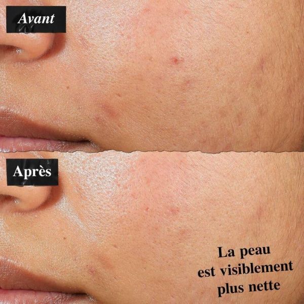 Lotion anti-imperfections - 60 ml